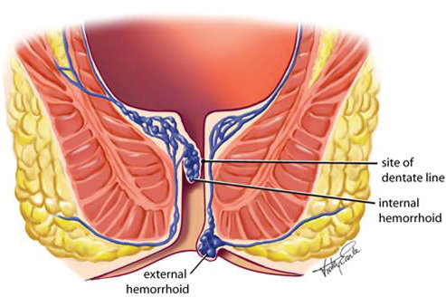Hemorrhoidal banding anatomy Anatomy of hemorrhoidal banding